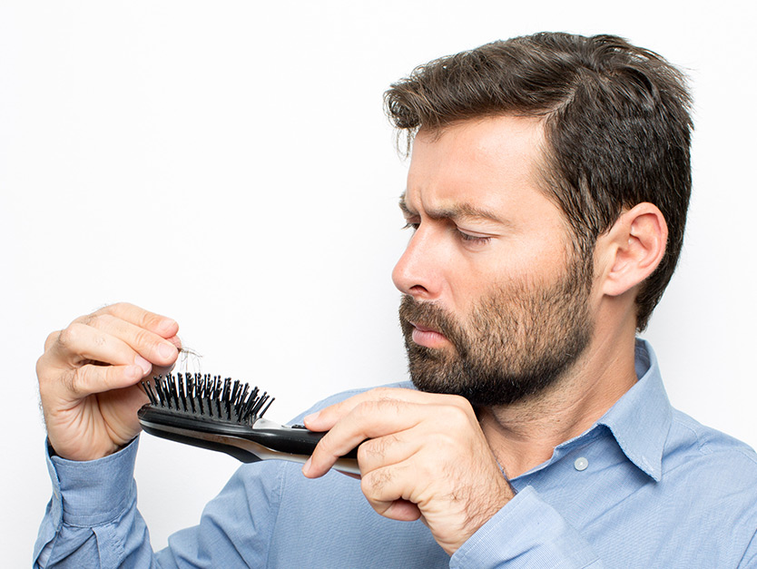 Hair loss, when to worry: the relationship between inheritance and alopecia